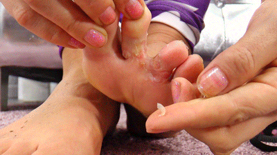 Foot fungus - I have it and YOU want it! (SD Video)
